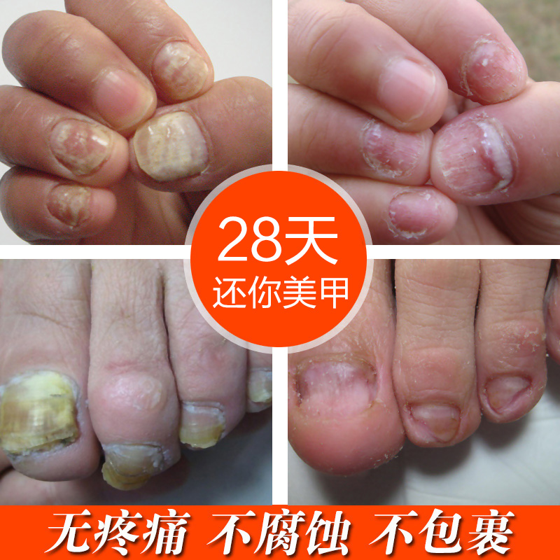 希妃施灰指甲膏批發(fā) 灰指甲液 灰指甲水套裝灰甲亮 OEM貼牌